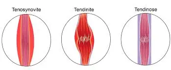 pathologies d'un tendon tendinite et kiné à 1190 bruxelles forest